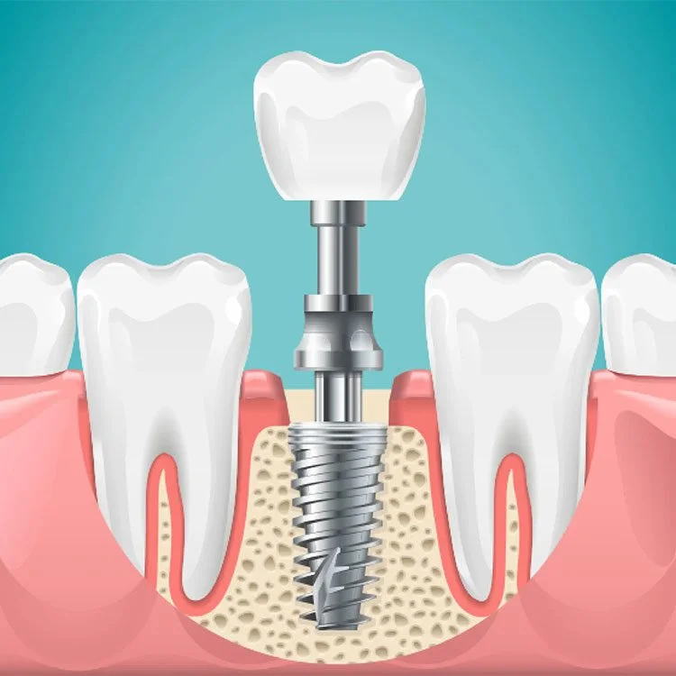 dental-implants-clinic-hyderabad-bangalore-750x750