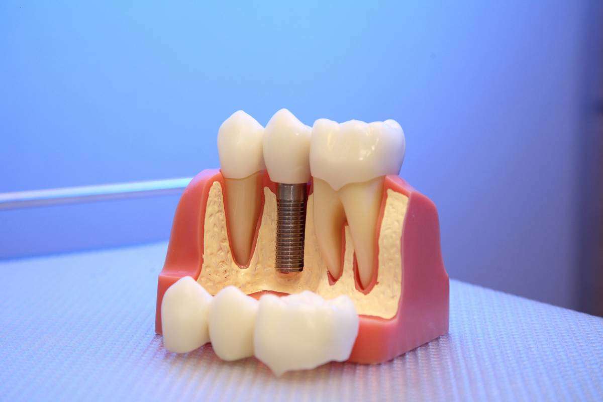 dental implant, model, plate, denture. Dental implant, artificial tooth roots into jaw, root canal of dental treatment, gum disease, teeth model for dentist studying about dentistry